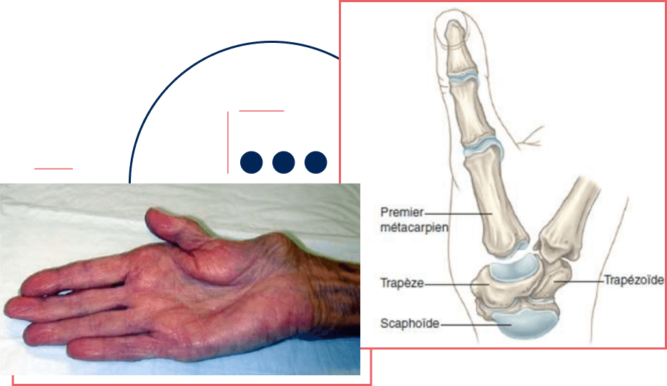 Rhizarthrose Limoges